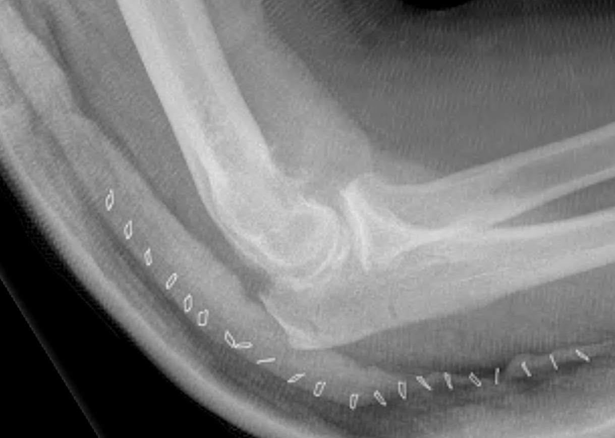 Elbow OK Procedure Lateral